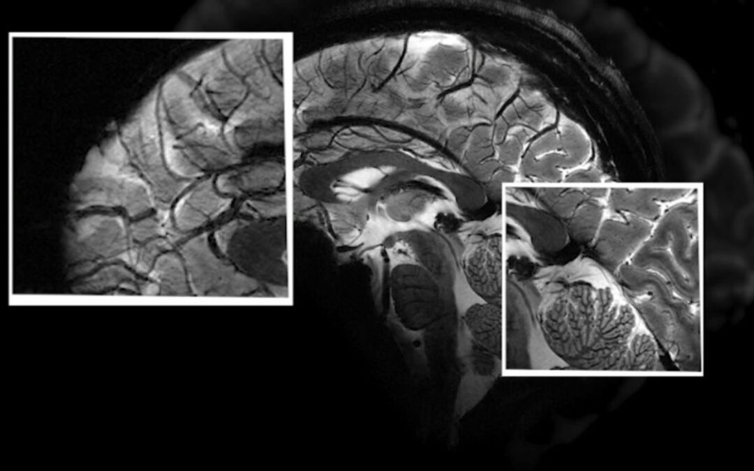 Dans les méandres de l&rsquo;esprit : L&rsquo;IRM iseult et la nouvelle ère de l&rsquo;imagerie cérébrale