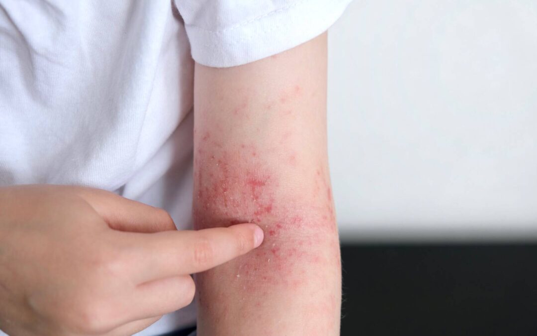 Écoutez, l&rsquo;eczéma est réel : Une journée pour tout changer