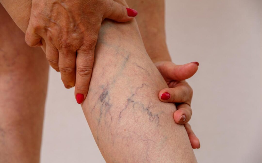 Les varices : Un combat moderne pour 20 Millions de Français