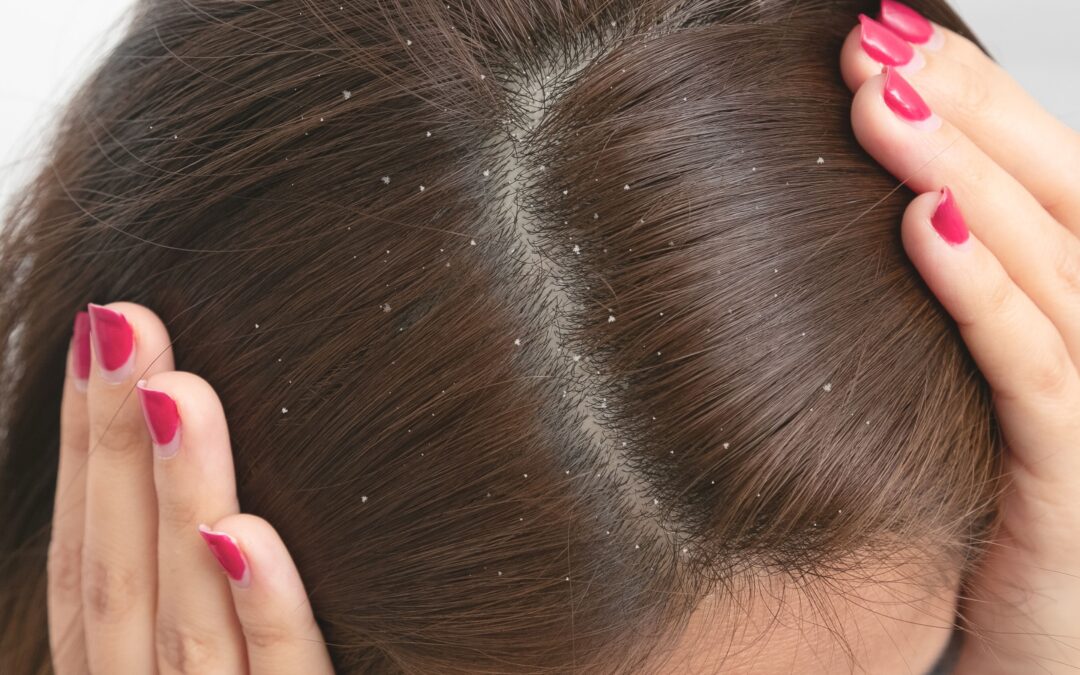 Pellicules : L&rsquo;ennemi invisible de notre génération